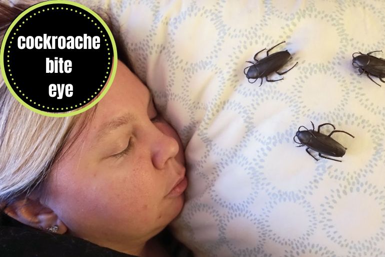 Cockroach Bite Eye symptoms