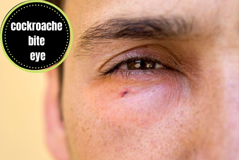 cockroache bite eye symptoms
