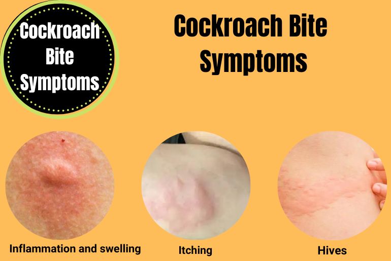 Cockroach Bite Symptoms