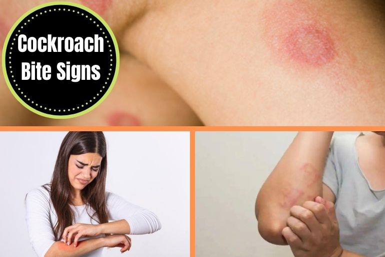 Cockroach Bite Signs