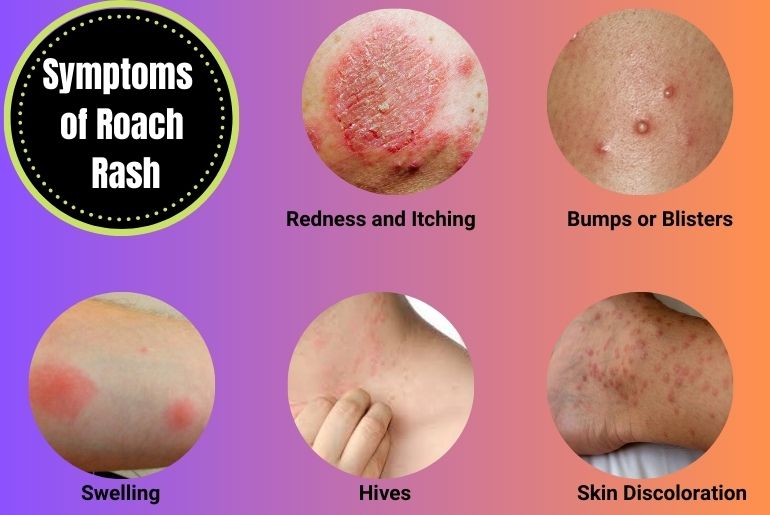 Symptoms of Roach Rash